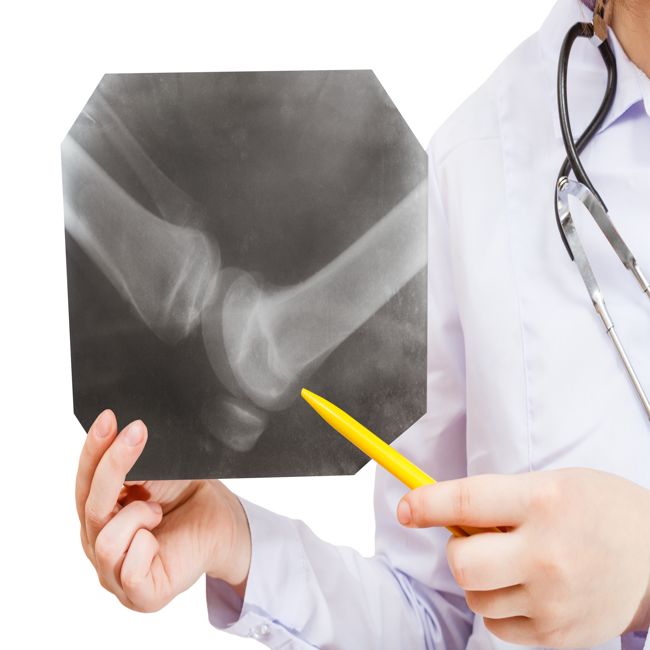 Kennis over osteoporose en fractuurrisico schiet tekort